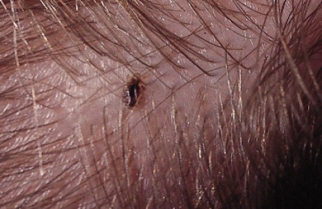 Get Rid of Lice! Head Lice Symptoms, Head Lice Treatment