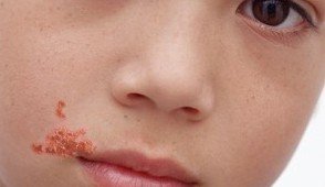 Impetigo – What is It, What Causes It and Is it Just a Cold Sore?