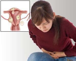 Fibroids and Healing Them Naturally