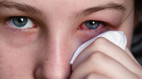 How to Help Heal Pinkeye (Conjunctivitis)