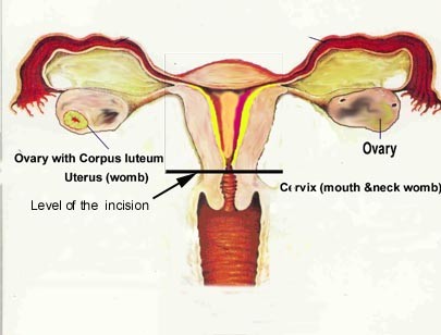 Full Versus Partial Hysterectomies