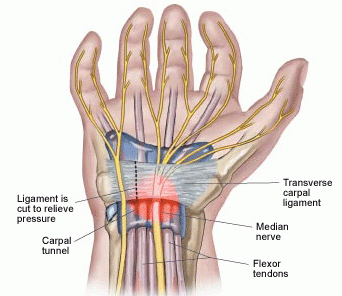 Healthy Joints: Coping with Carpal Tunnel Syndrome