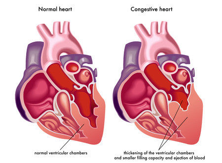 Alternative Treatments for Congestive Heart Failure