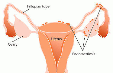 Natural Remedies for Endometriosis