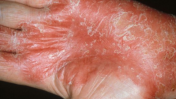 Natural Ways to Manage, Treat Psoriasis